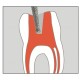Fresa endodontica diamantata Rotonda ad estensione lunga 013 (5pz)